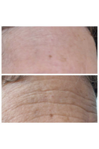 8 milyon mikro iğne içeren 24K Anti-Aging kremi, 1000 ppm altın içerir, anında botoks etkili 8 milyon mikro iğne içeren 24K Anti-Aging kremi, 1000 ppm altın içerir, anında botoks etkili