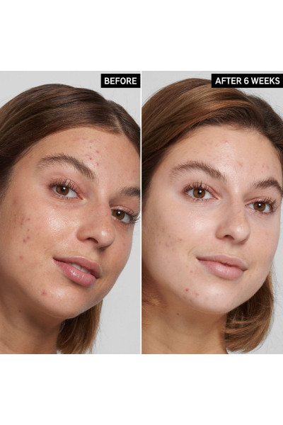 Salicylic Acid Acne + Pore Cleanser 150 Ml Salicylic Acid Acne + Pore Cleanser 150 Ml